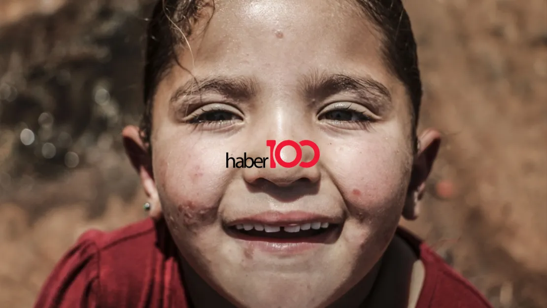 Şark Çıbanı (Leishmaniasis): Nedir, Belirtileri, Tanı ve Tedavileri, İzi ve Evreleri, Önlenmesi Önerileri ve Sıkça Sorulan Sorular
